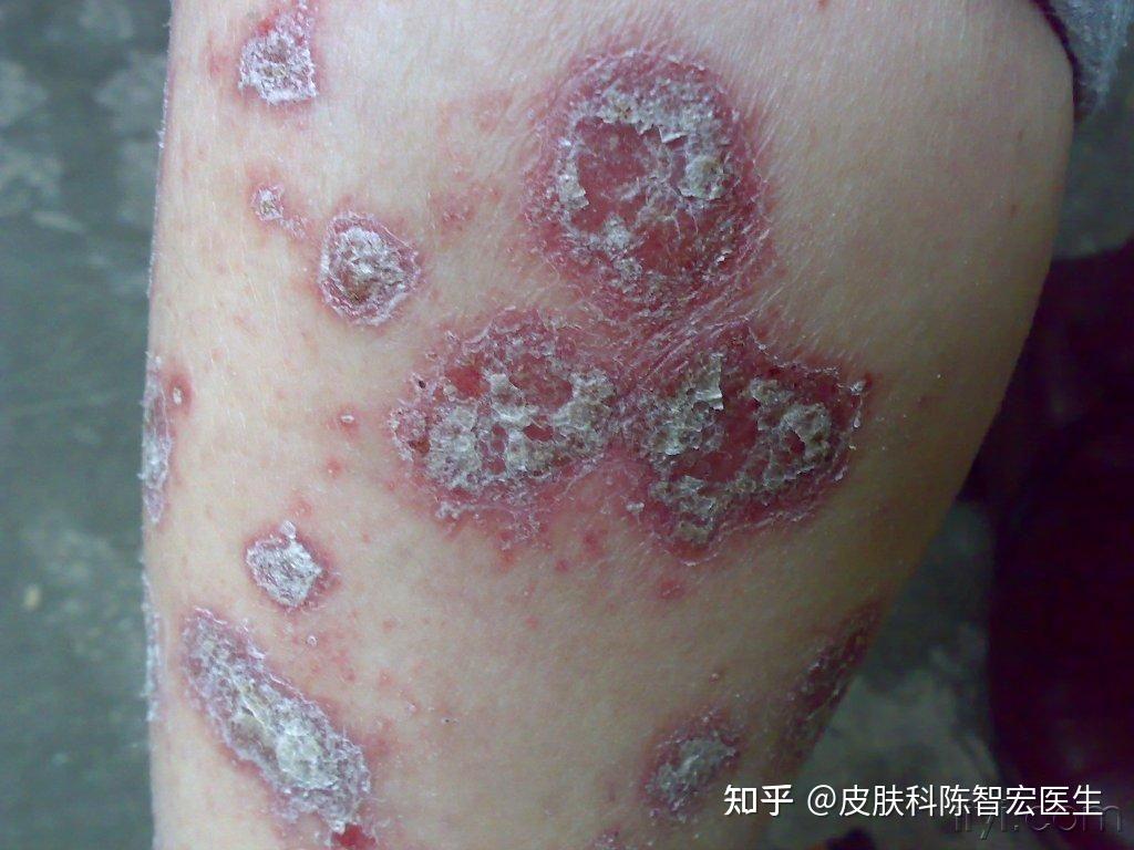 银屑病会引发其他疾病吗