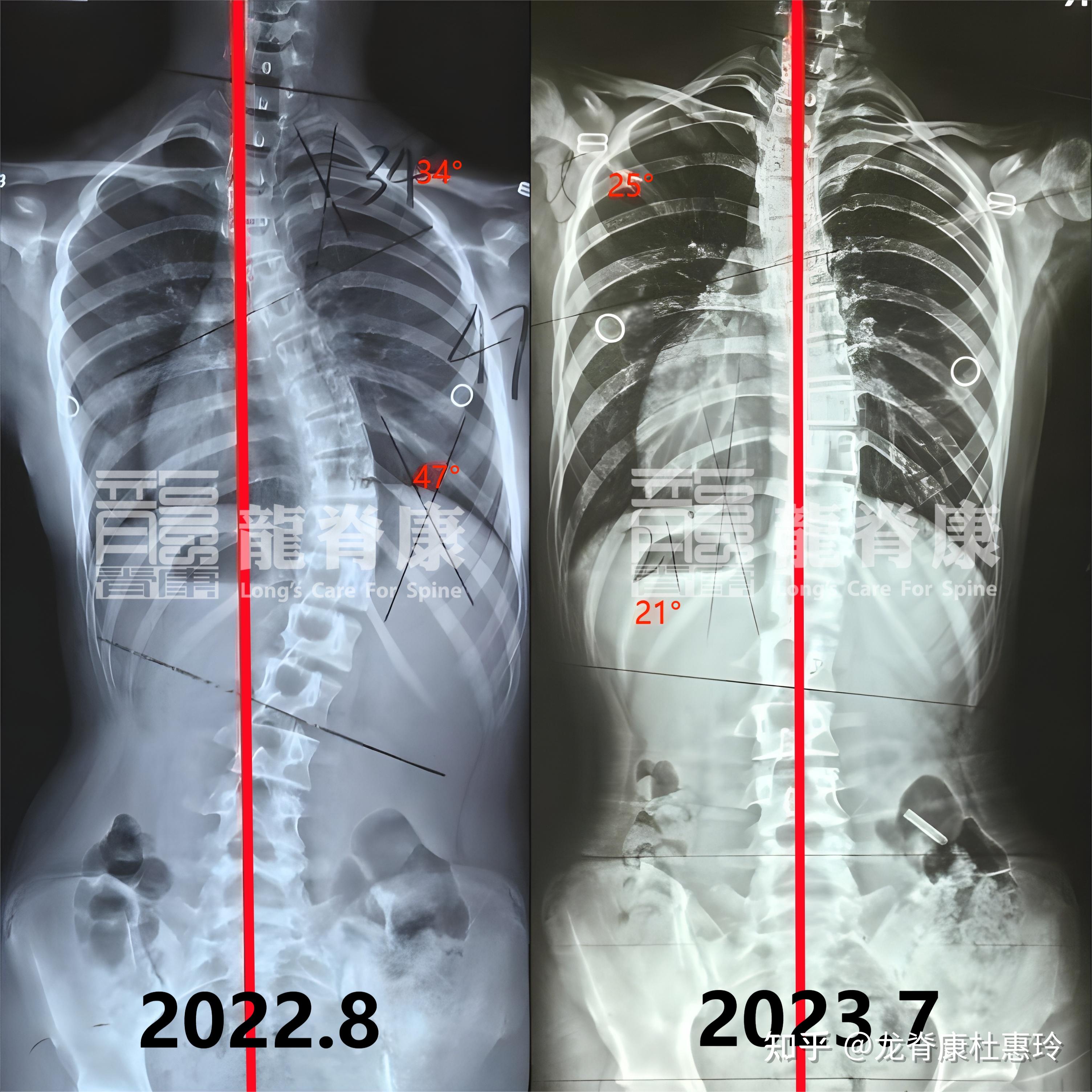 脊柱侧弯180度图片图片