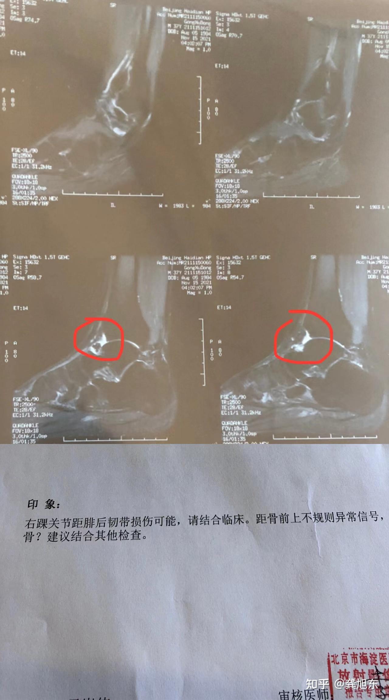 核磁共振图片 脚踝图片