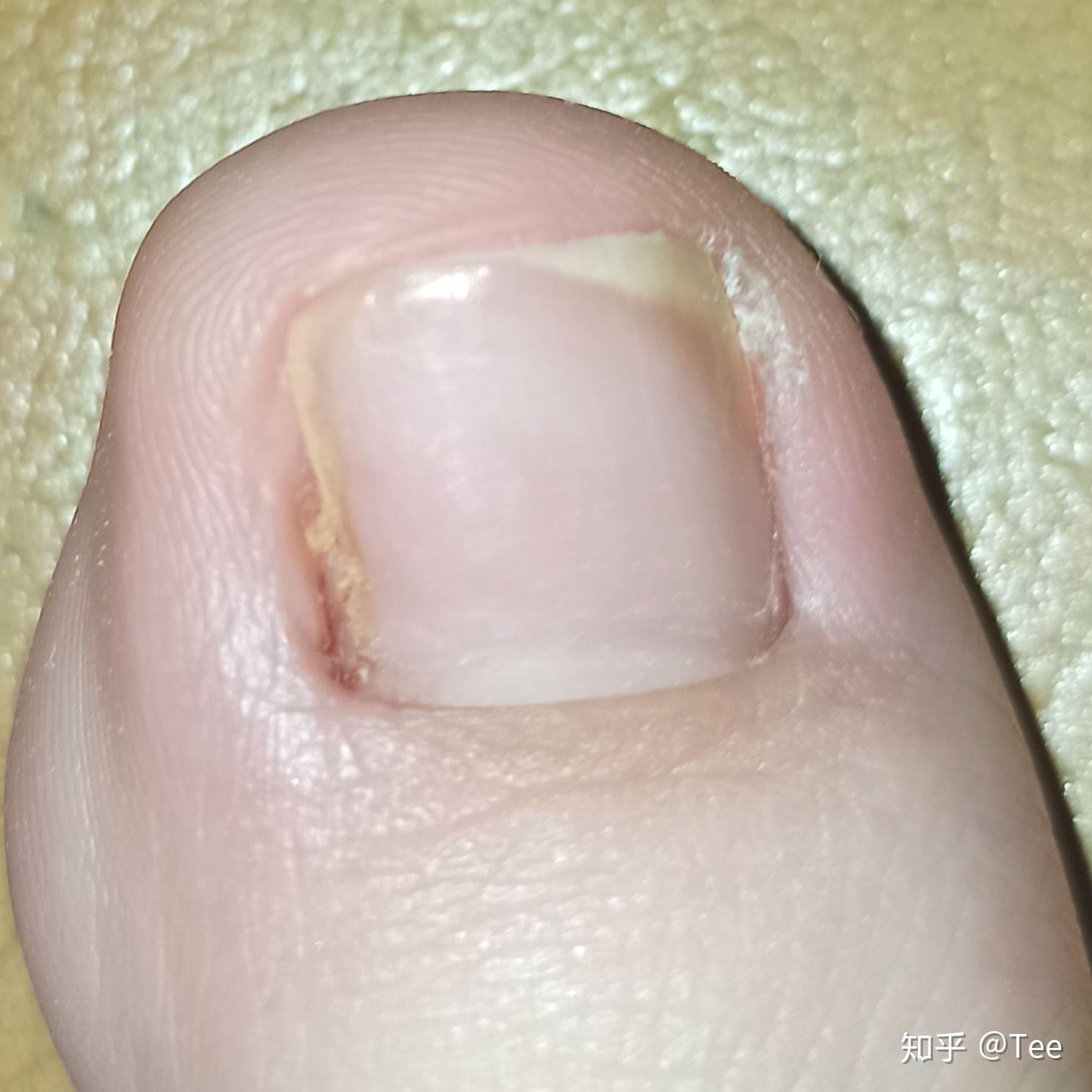 嵌甲甲沟炎附图