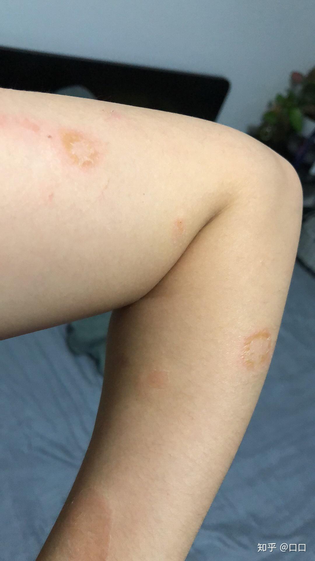 不养猫为什么会得铜钱藓猫藓