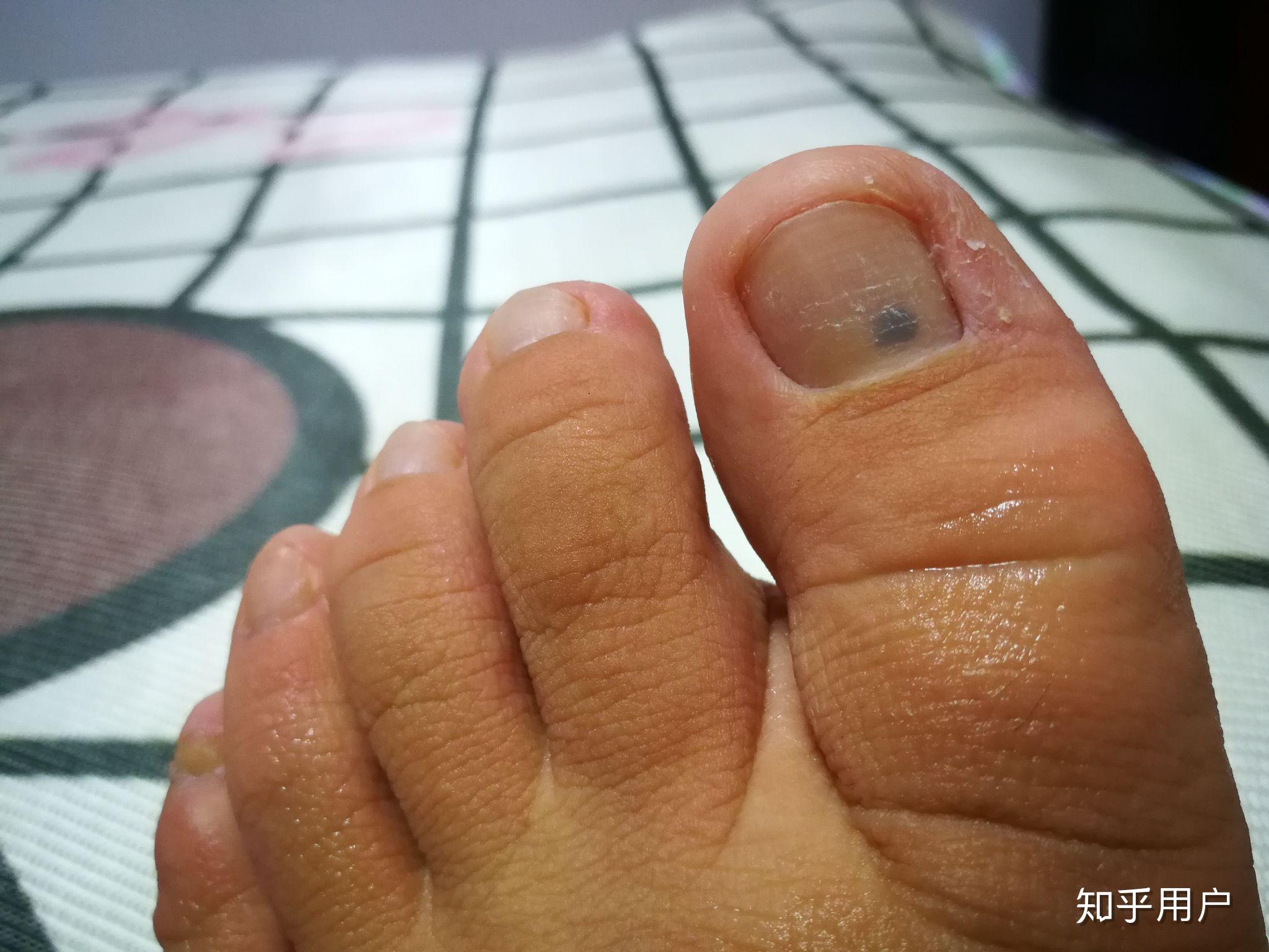 脚趾甲里出现一黑点是怎么回事? - 知乎