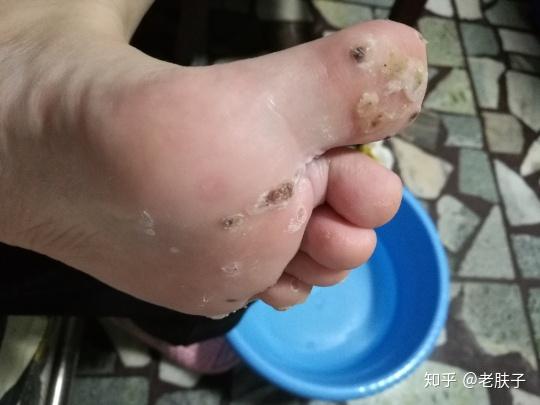 治療蹠疣不影響生活的方法