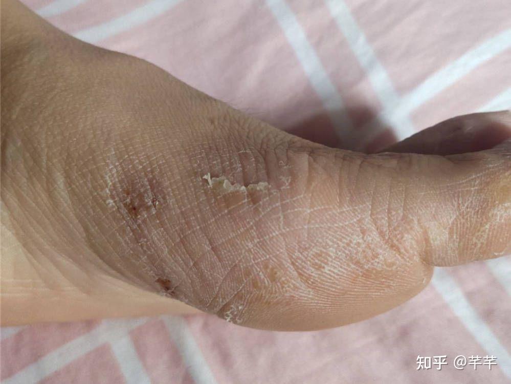 脚气即足癣,是由一种或多种真菌引起的传染性皮肤问题,引起脚气的真菌