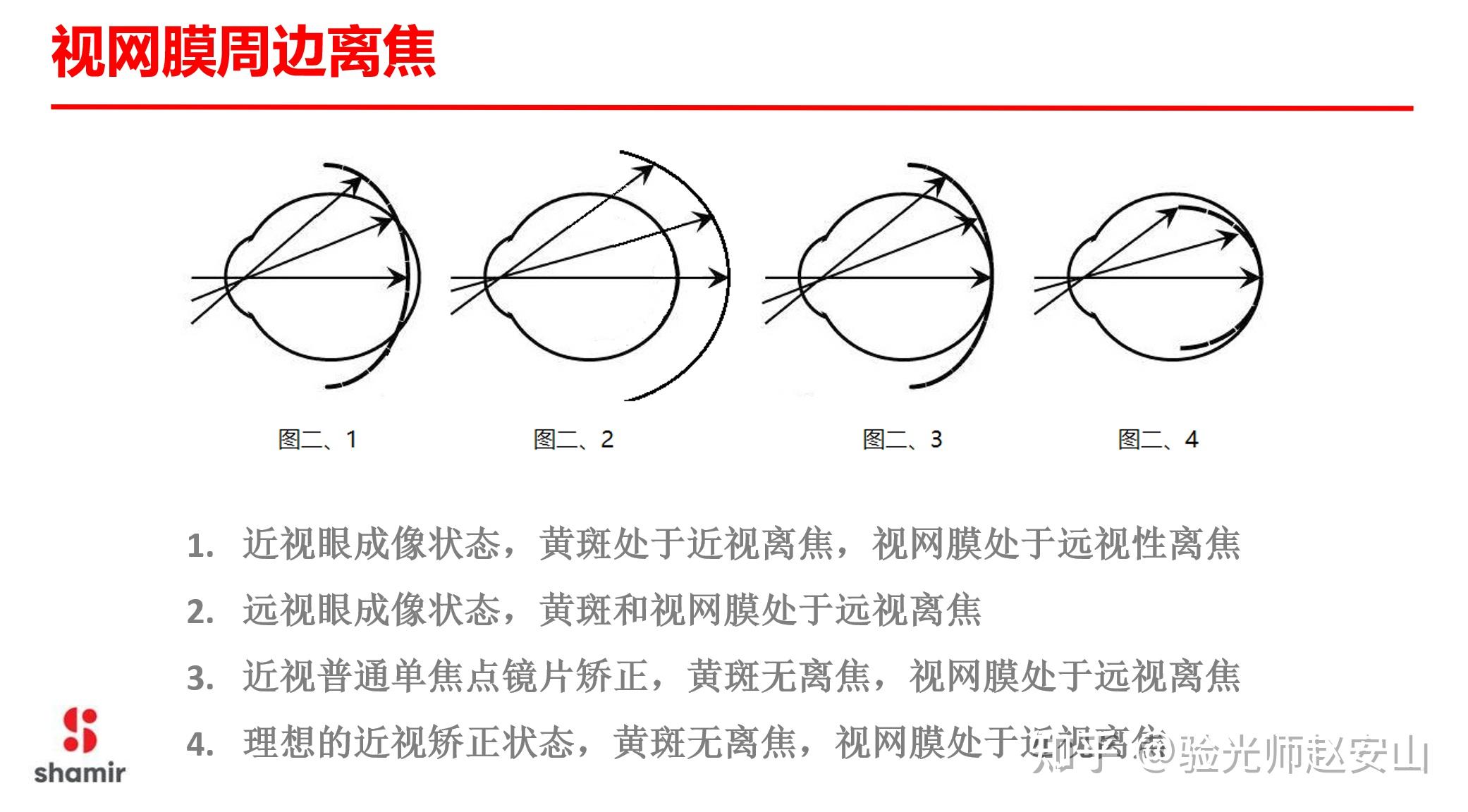 近视控制型离焦镜片管用吗?它控制近视度数的原理是什么? - 知乎