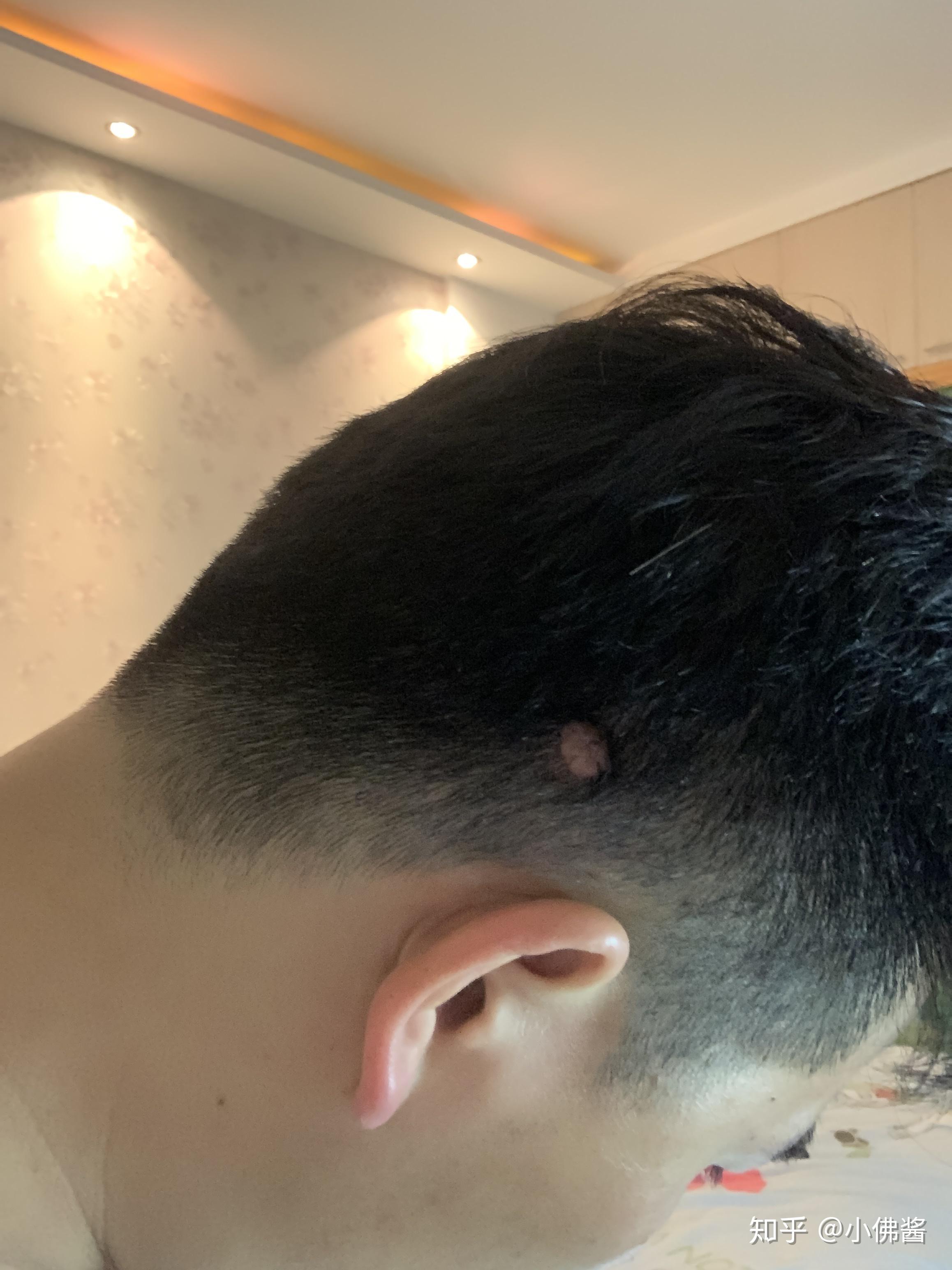 后脑勺长了一个肉疙瘩?