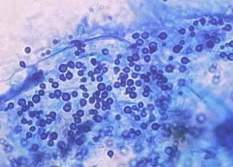 毛囊炎、疖、痈、皮脂腺囊肿怎么区分? - 知乎