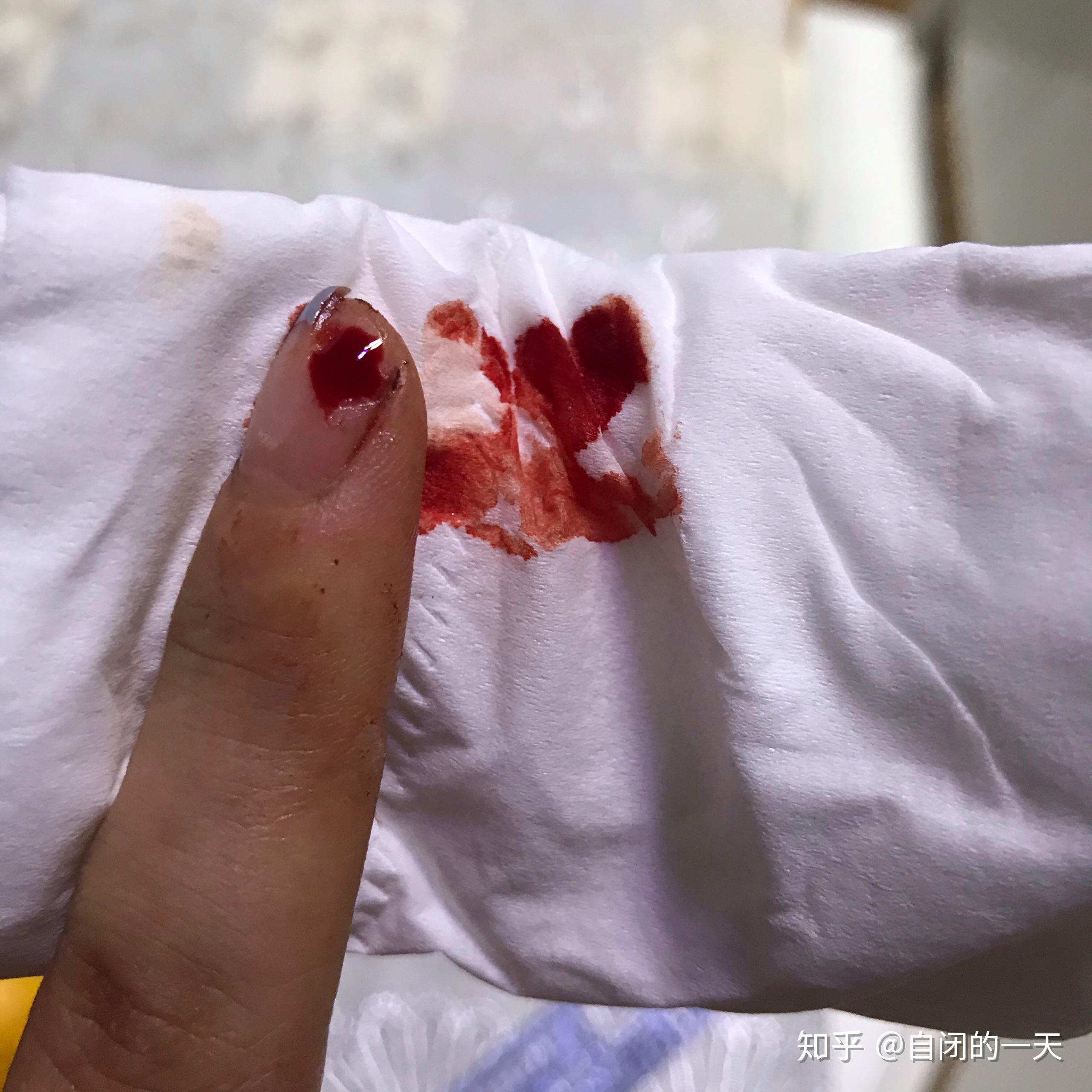 手指被割掉一块肉是什么体验? - 知乎