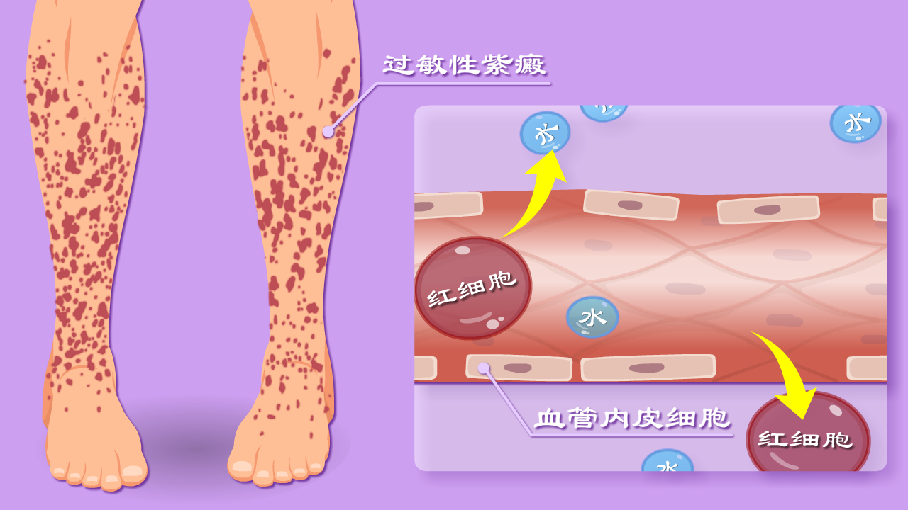 过敏性紫癜,很严重吗? - 知乎