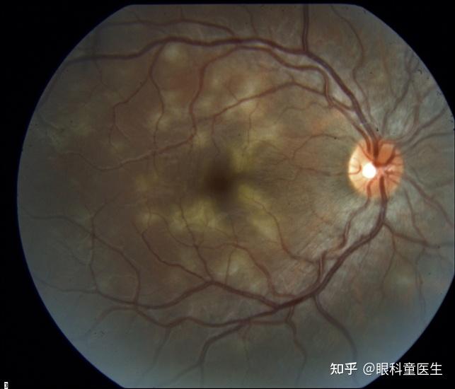 后葡萄膜炎18急性后极部多灶性鳞状色素上皮病变