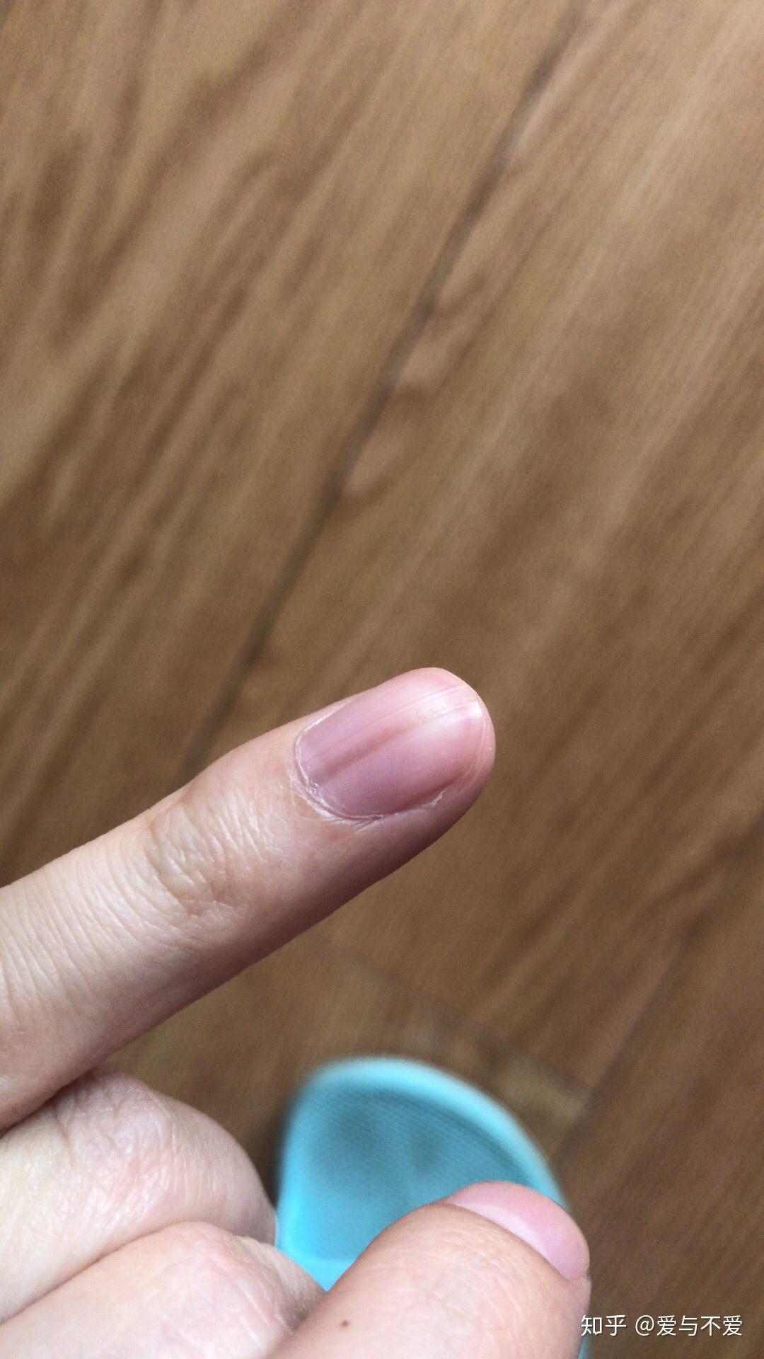 指甲上有一条淡淡黑线,怎么回事?两年了. - 知乎