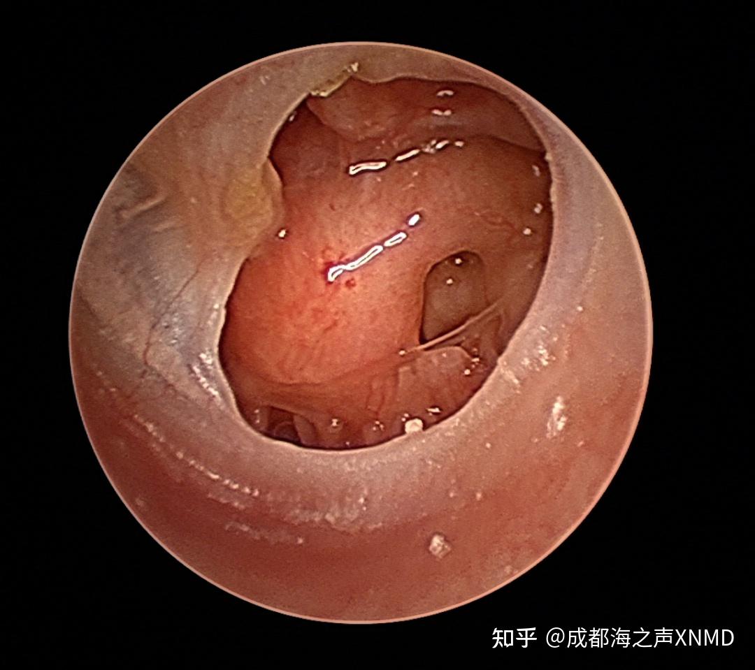 怎么判断自己耳膜有没有破裂? - 知乎
