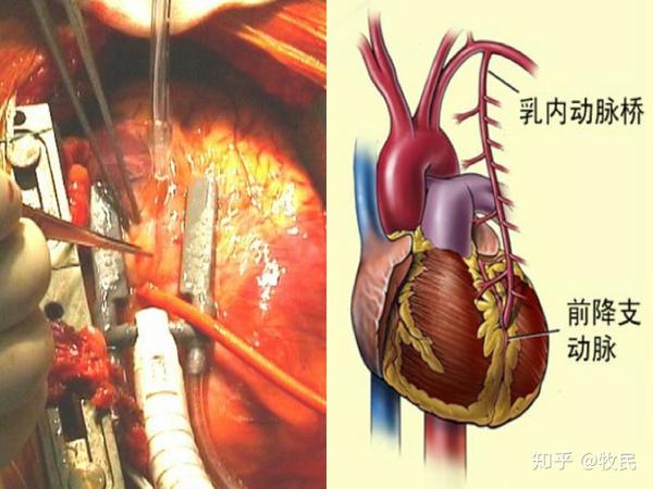 心脏球囊扩张术图解图片