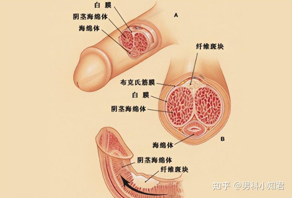 陰莖硬結症(peyronie disease pd)又稱陰莖纖維性海綿體炎,海綿體硬化