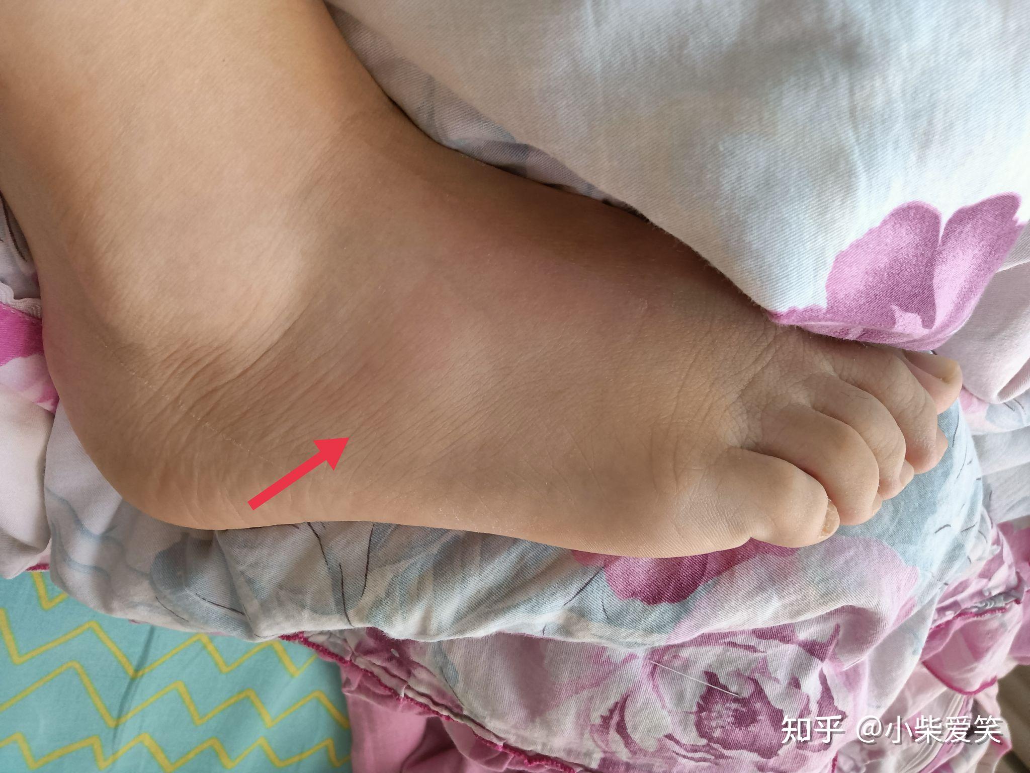 崴脚好久了但是好了之后一直有个包不痛不痒运动也没妨碍但是一直不消