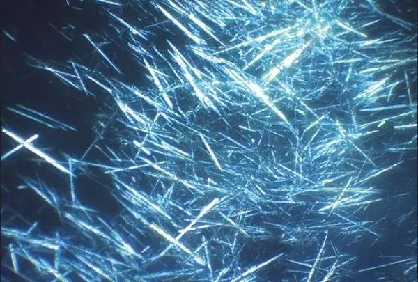 这些针状的结晶体实际上是 尿酸的结晶.