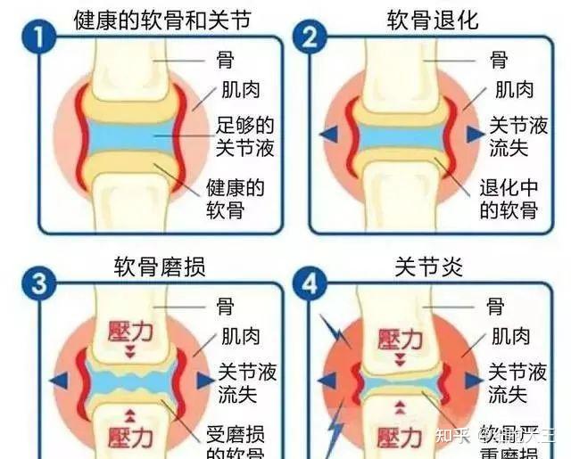 齐鲁健康：干细胞疗法成为骨关节炎的终极克星 知乎 