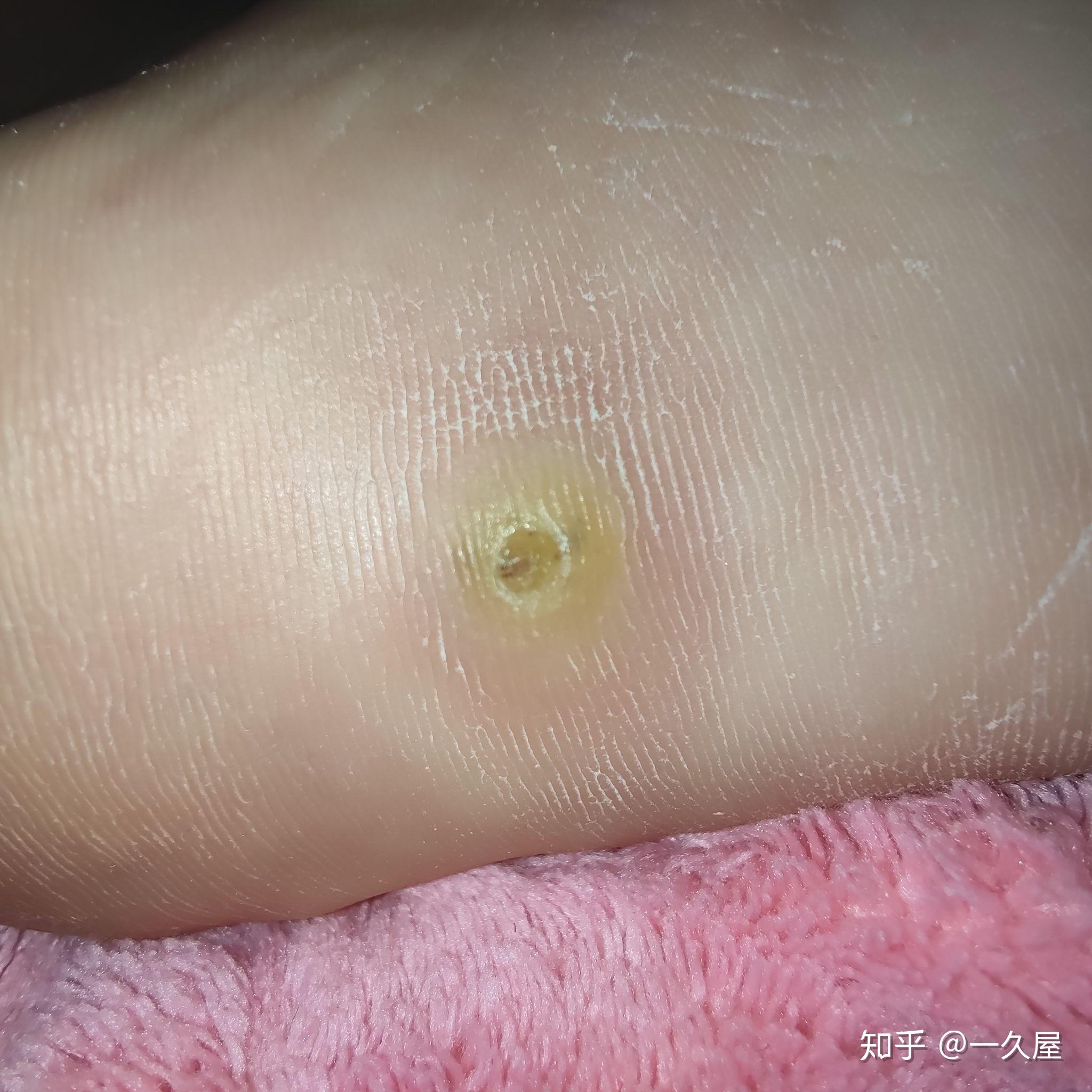 我的跖疣终于好了治疗过程
