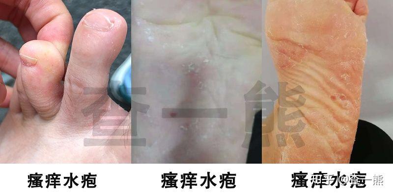 角化型和水泡型足癬怎麼徹底治療