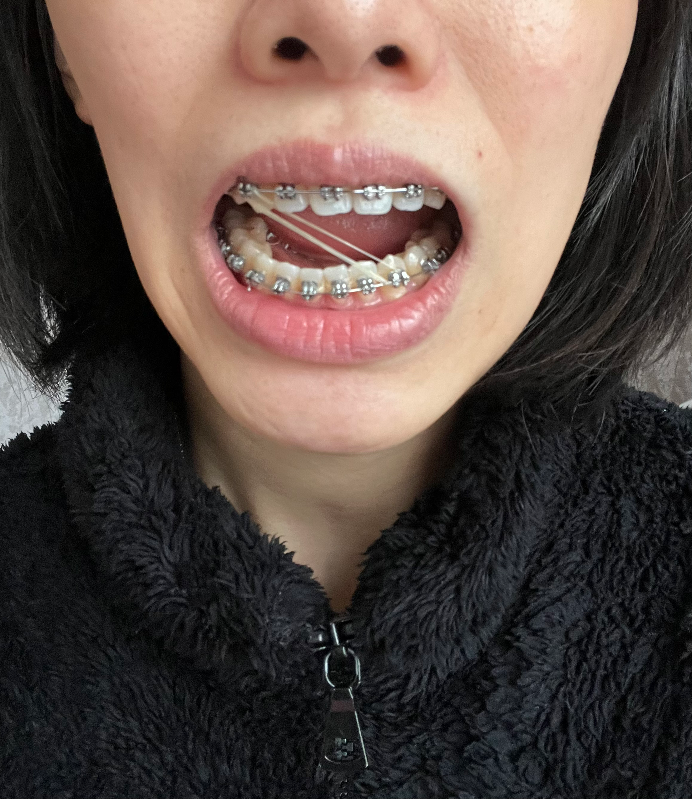 严重偏颌,两位医生给了两套方案,不知道该做怎样的选择? - 知乎