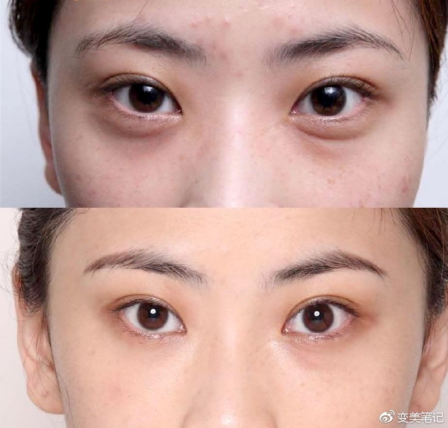 泪沟是指由内眼角开始出现在下眼睑靠鼻侧的一条凹沟填充泪沟后会使得