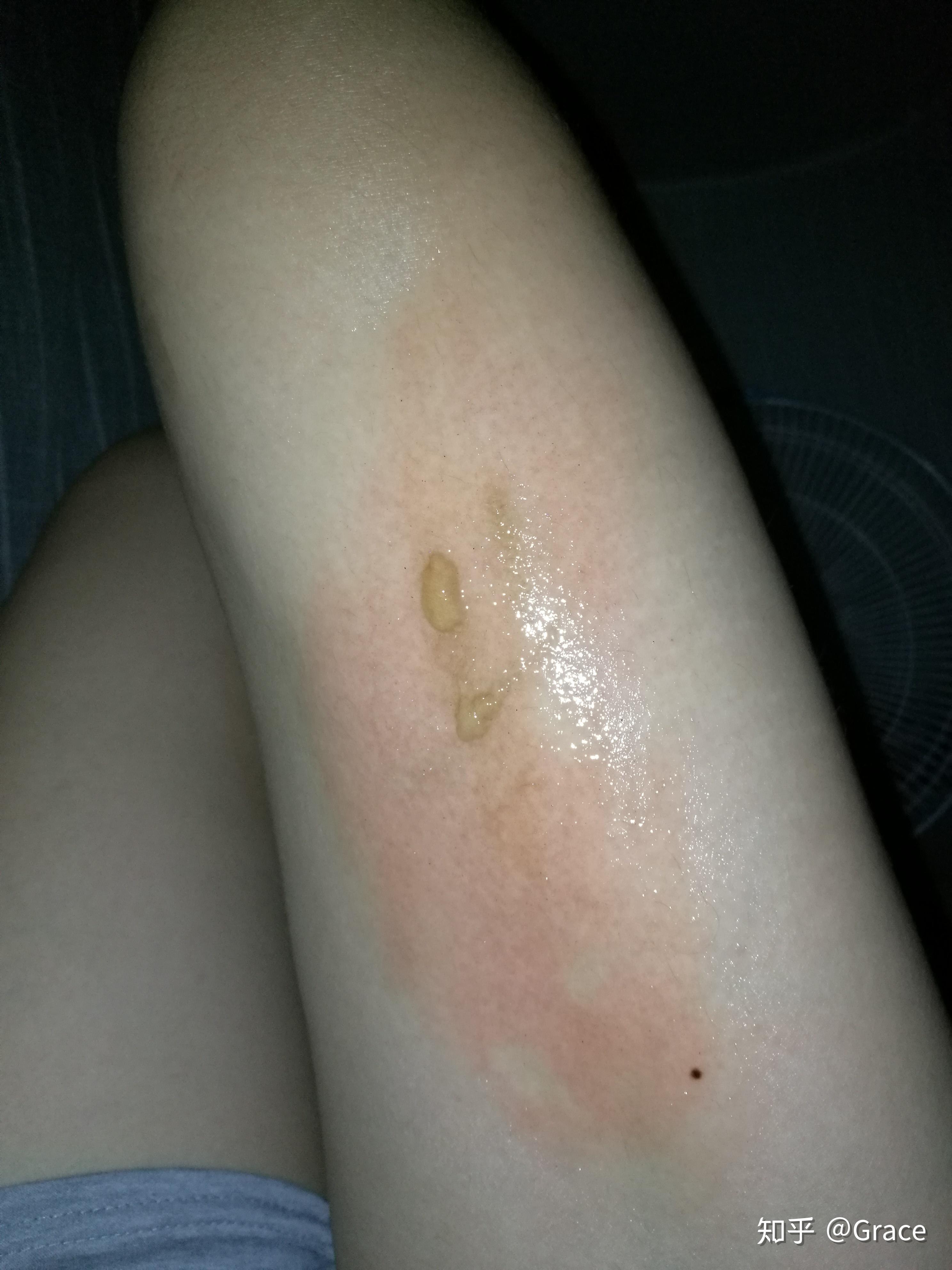 记录被95℃开水烫伤的一个月