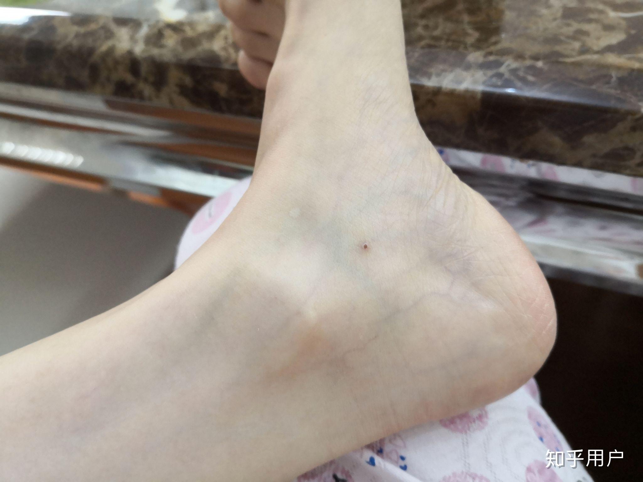 为什么皮肤上看到明显青绿色血管