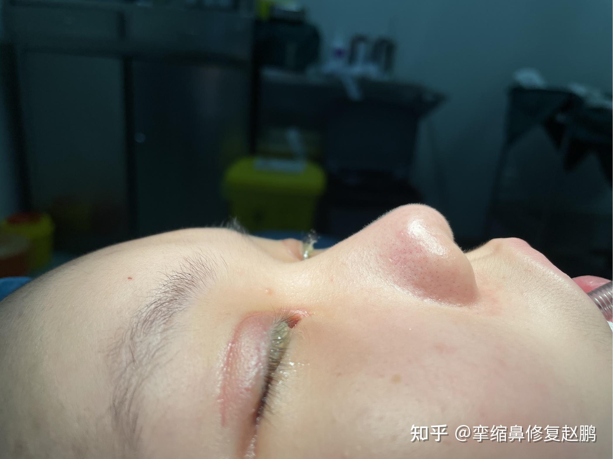 短鼻应该如何做隆鼻手术