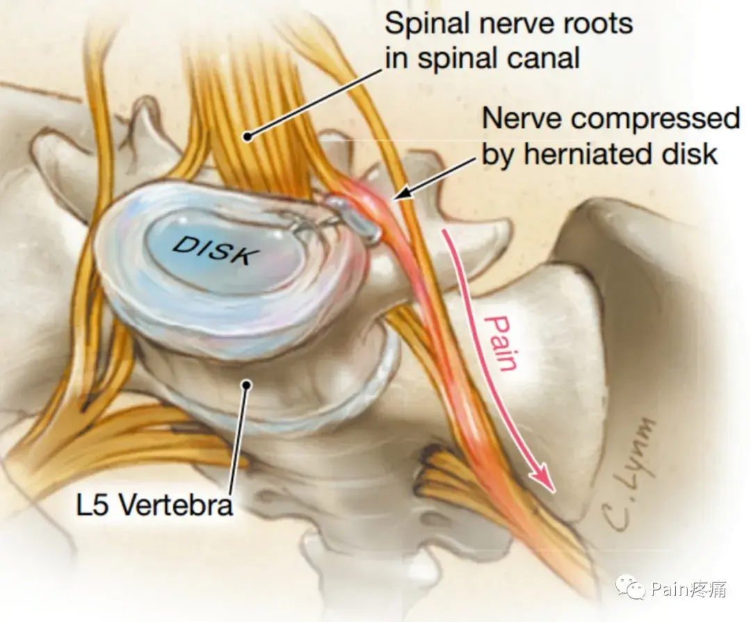 坐骨神经痛sciatica