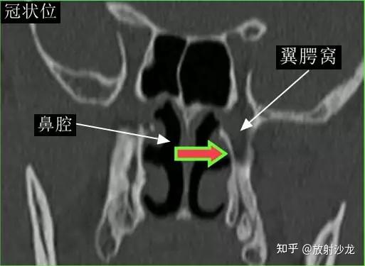 翼顎窩的ct影像解剖