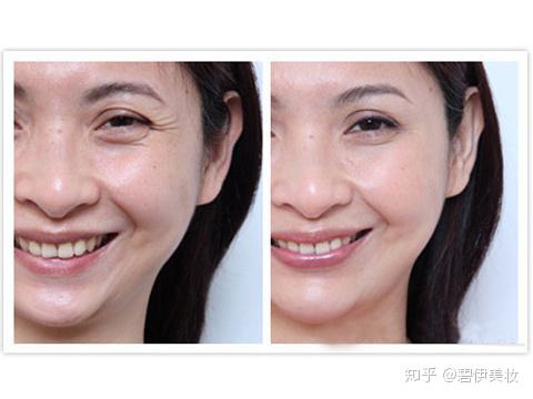 皱纹产生的机理 - 知乎
