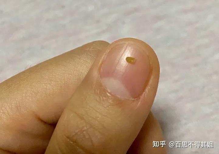 这个到底算不算黑头而且该怎么办啊
