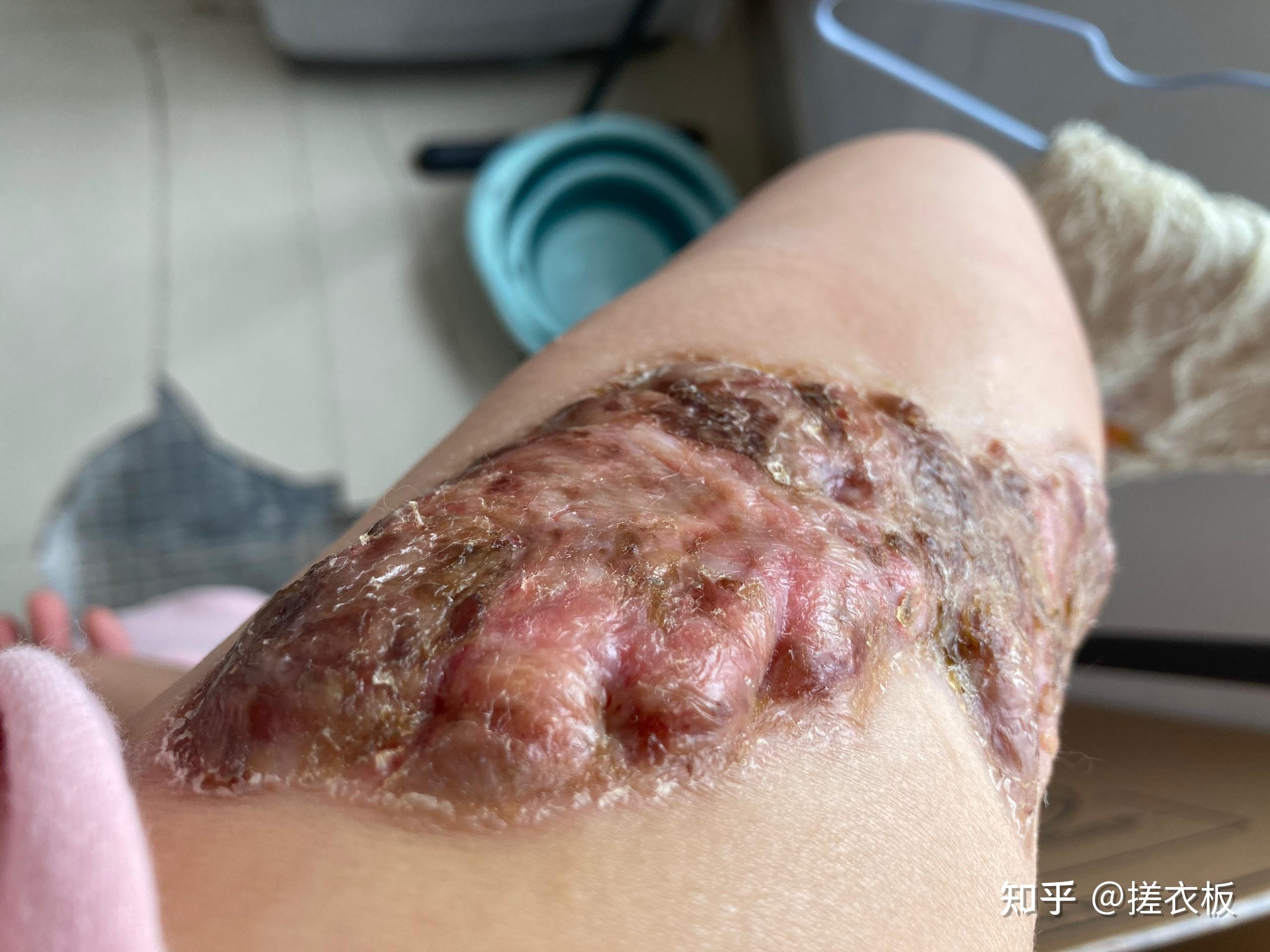 瘢痕体质的人这一生有什么样的体验