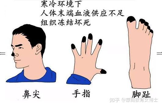生命之源:警惕冻伤风险:南方小土豆的冰雪之旅,真得会冻掉耳朵! - 知乎