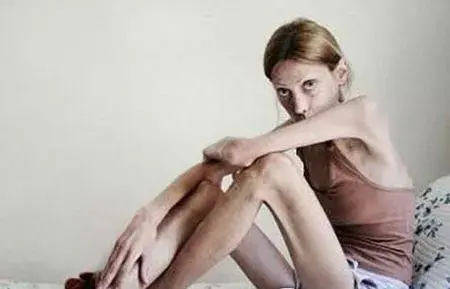 卡罗之死厌食症致死的模特