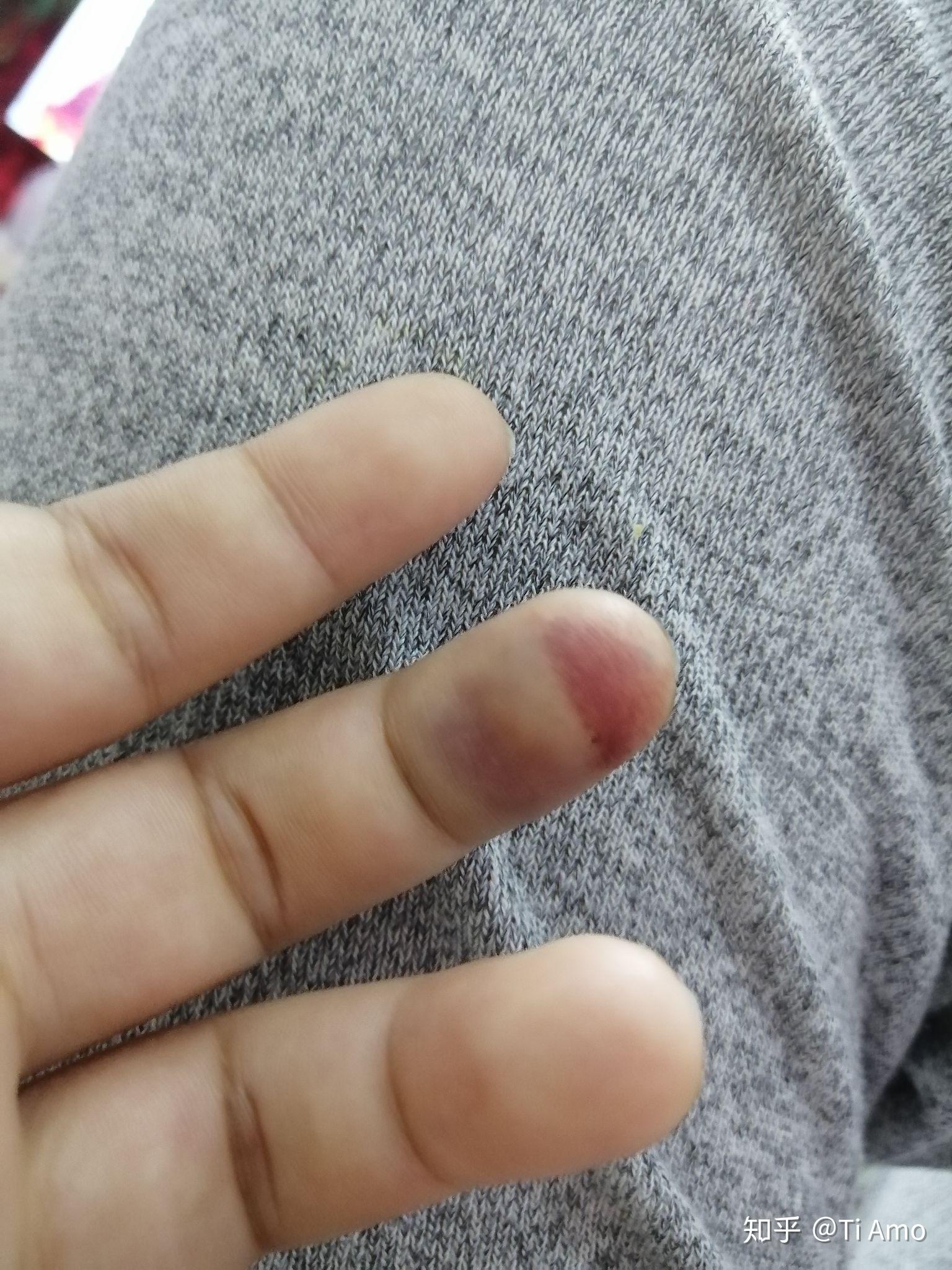 手指头被夹伤后,你是什么样的感受,怎么处理的? - 知乎