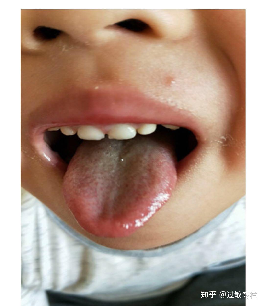 小孩肺热舌苔图片图片