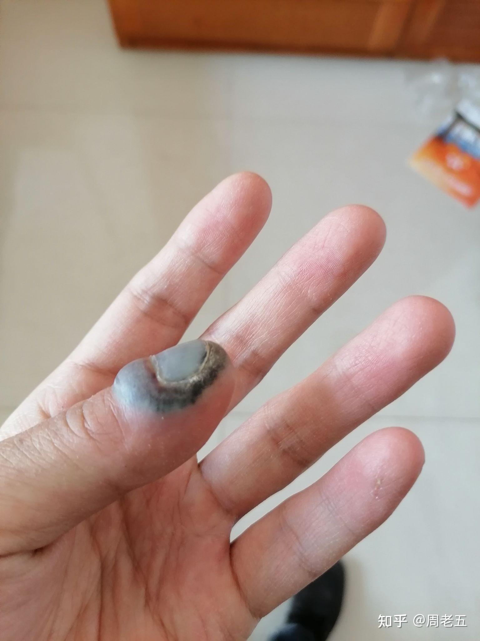 左脚大拇指被重物砸了 指甲内有淤血 特别疼 已经疼了一个晚上了 请问