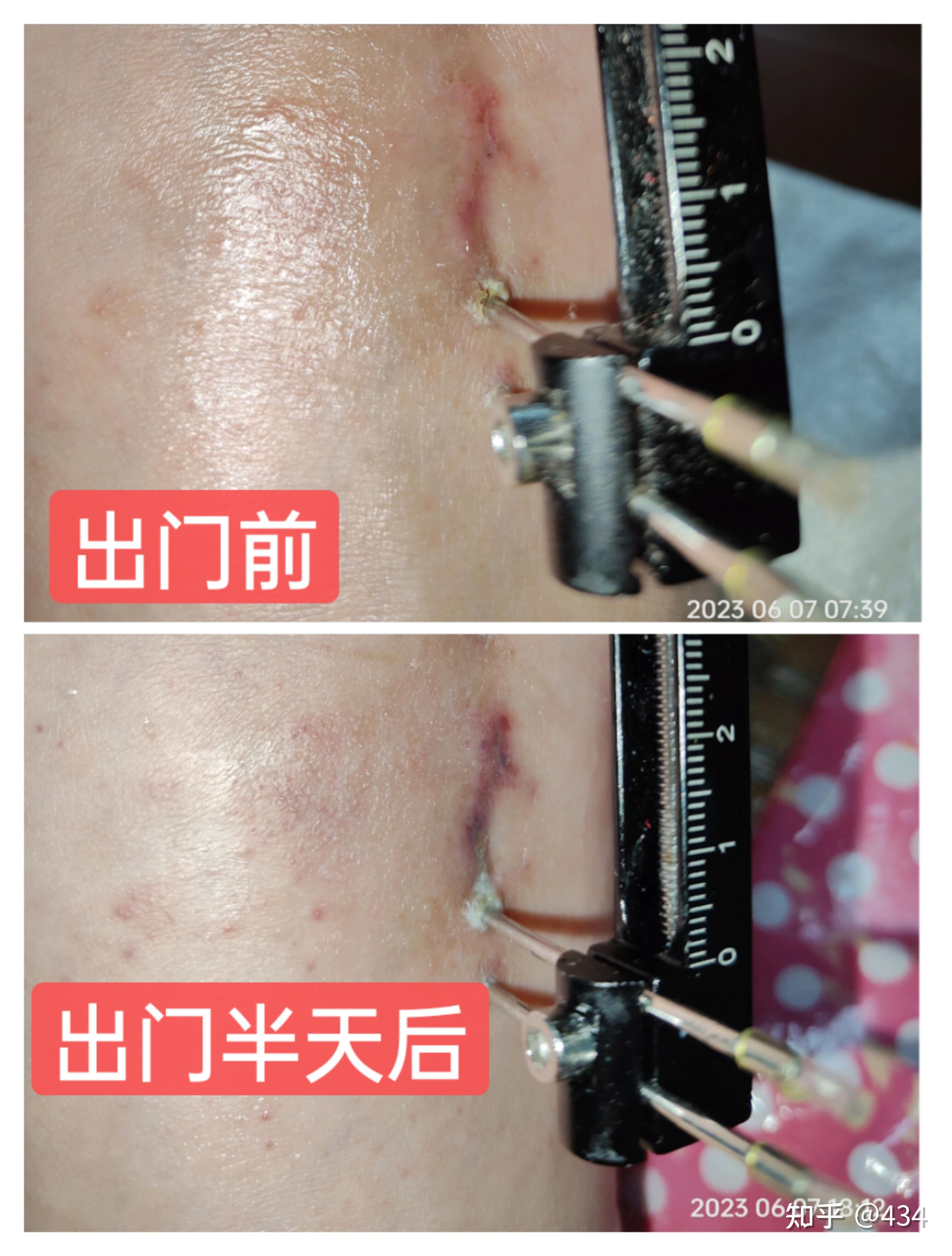 第四跖骨延长手术前后分享 - 知乎