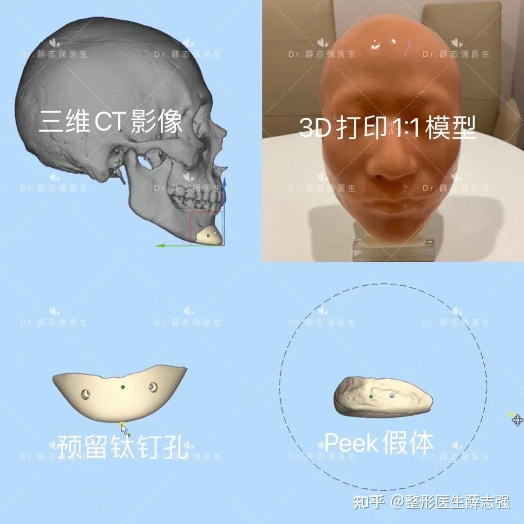 3D打印个性化钛合金骨修复假体的前驱探索与临床应用