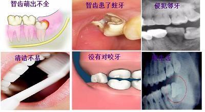 智齿为什么会横着长 智齿对牙齿矫正有帮助嘛 知乎 智齿为什么会横着长 智齿对牙齿矫正有帮助嘛 知乎