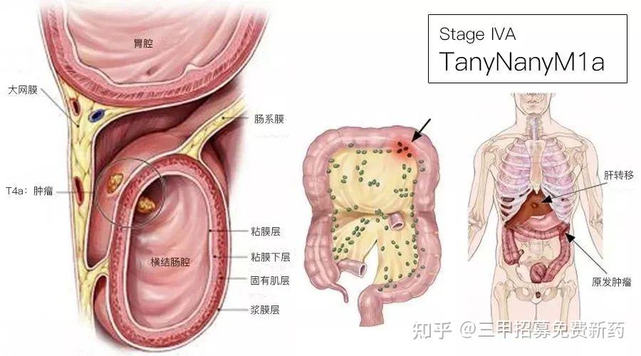 結直腸癌術後轉移率高這三個問題你需要了解