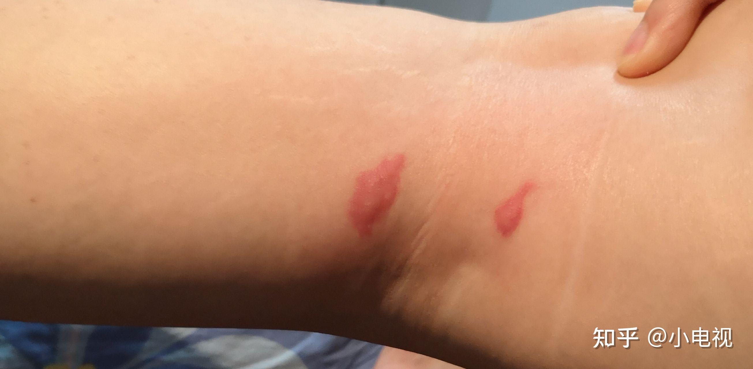 为什么我被蚊子咬了之后皮肤会变成类似淤青的紫红色,消退的很慢,肿的