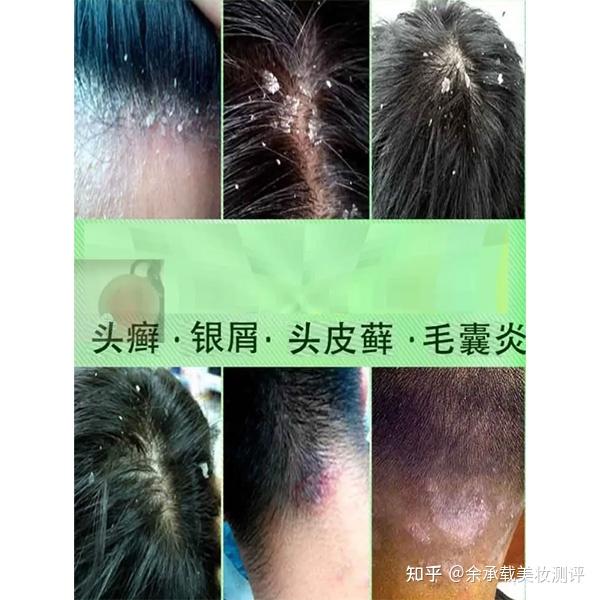 头上痒还有头皮屑用什么洗发水?氨基酸去屑洗发水排行 - 知乎