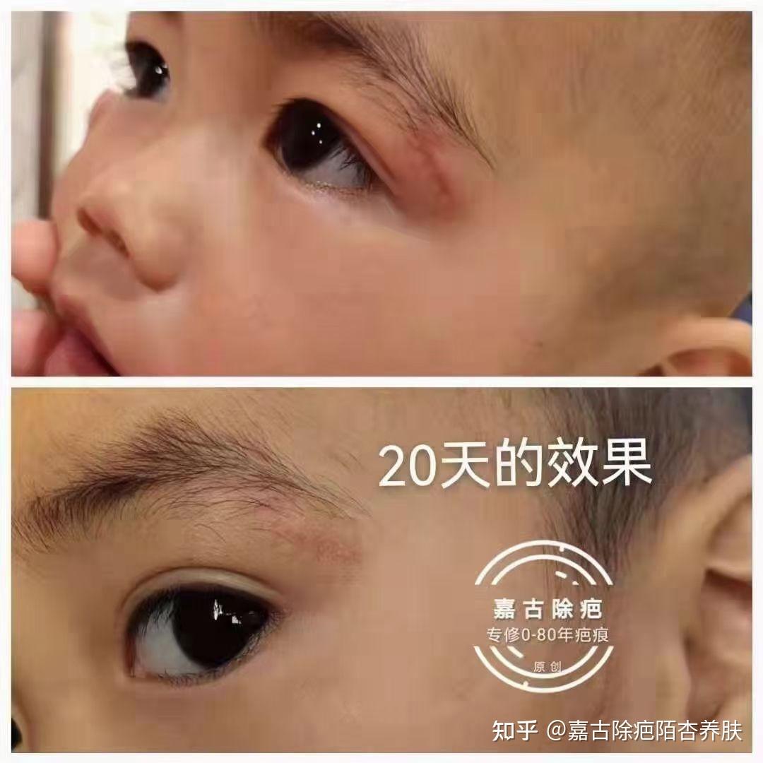 嘉古除疤 - 知乎