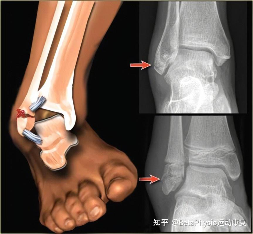 脚踝骨折brokenankle顺德倍他运动康复