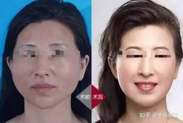 激光皮秒有副作用吗 v2-4977153bfce17e838340cfc7e96d8280_r.jpg