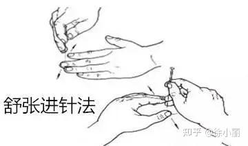 无痛针刺手法要诀 - 知乎