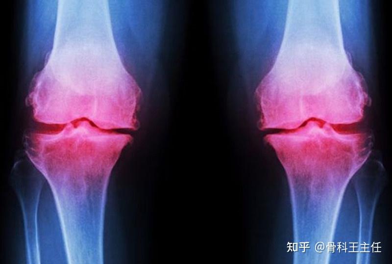 4种治疗骨关节炎的疗法，哪种适合你？ 知乎 