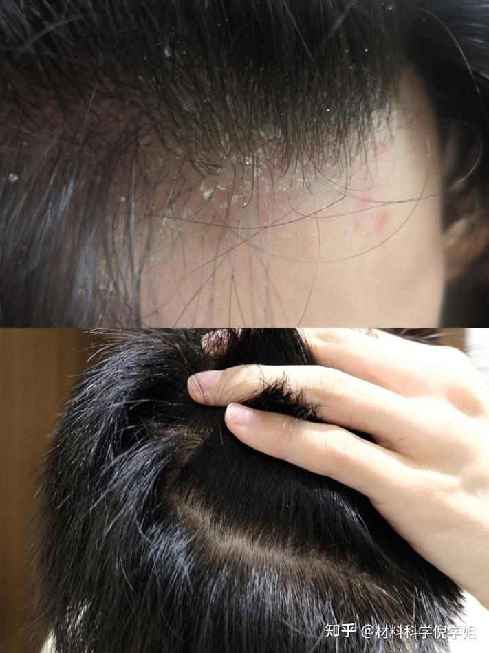 头皮螨虫算是一个比较常见又得不到重视的头皮问题了.